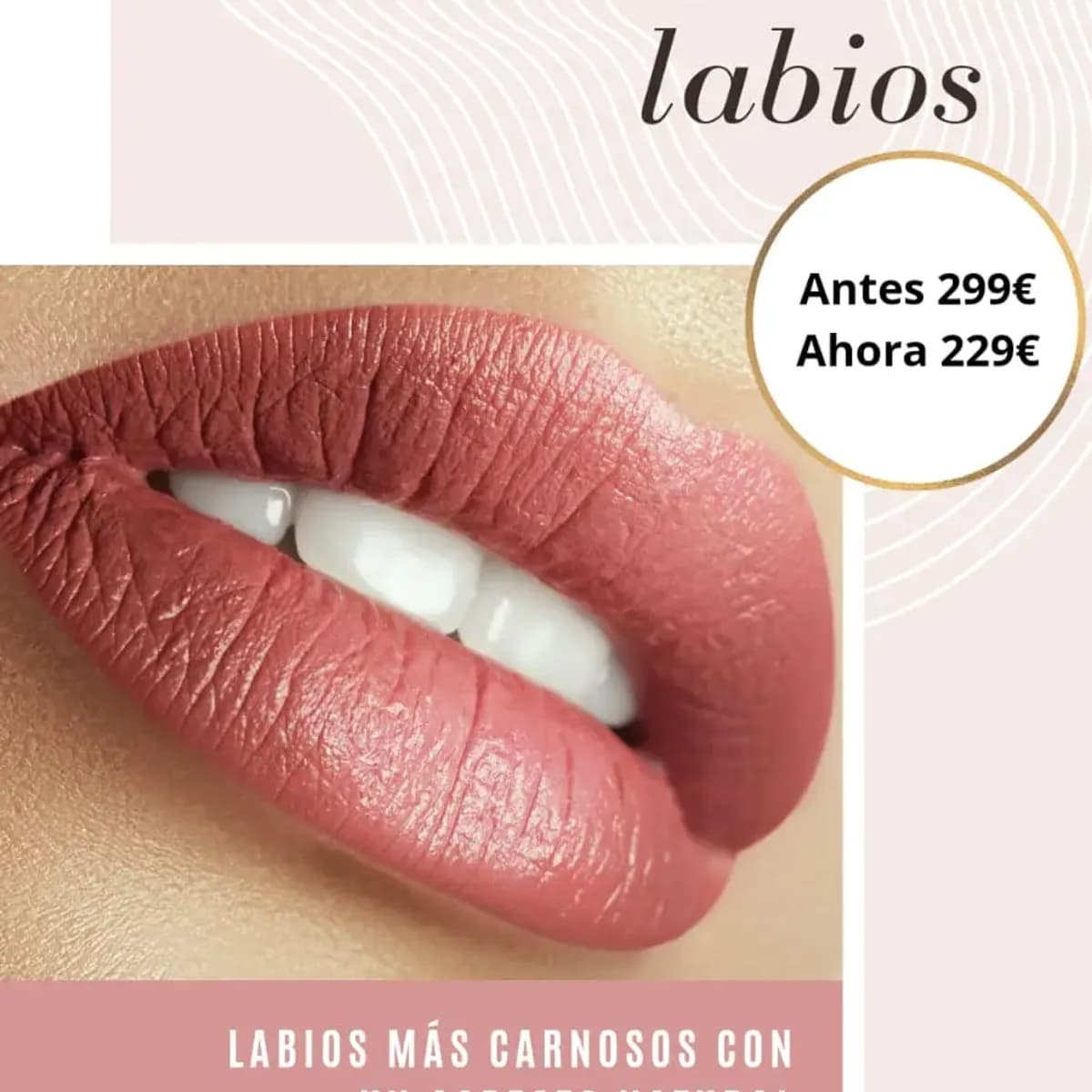 Relleno de Labios con Ácido Hialurónico - Aspecto Natural