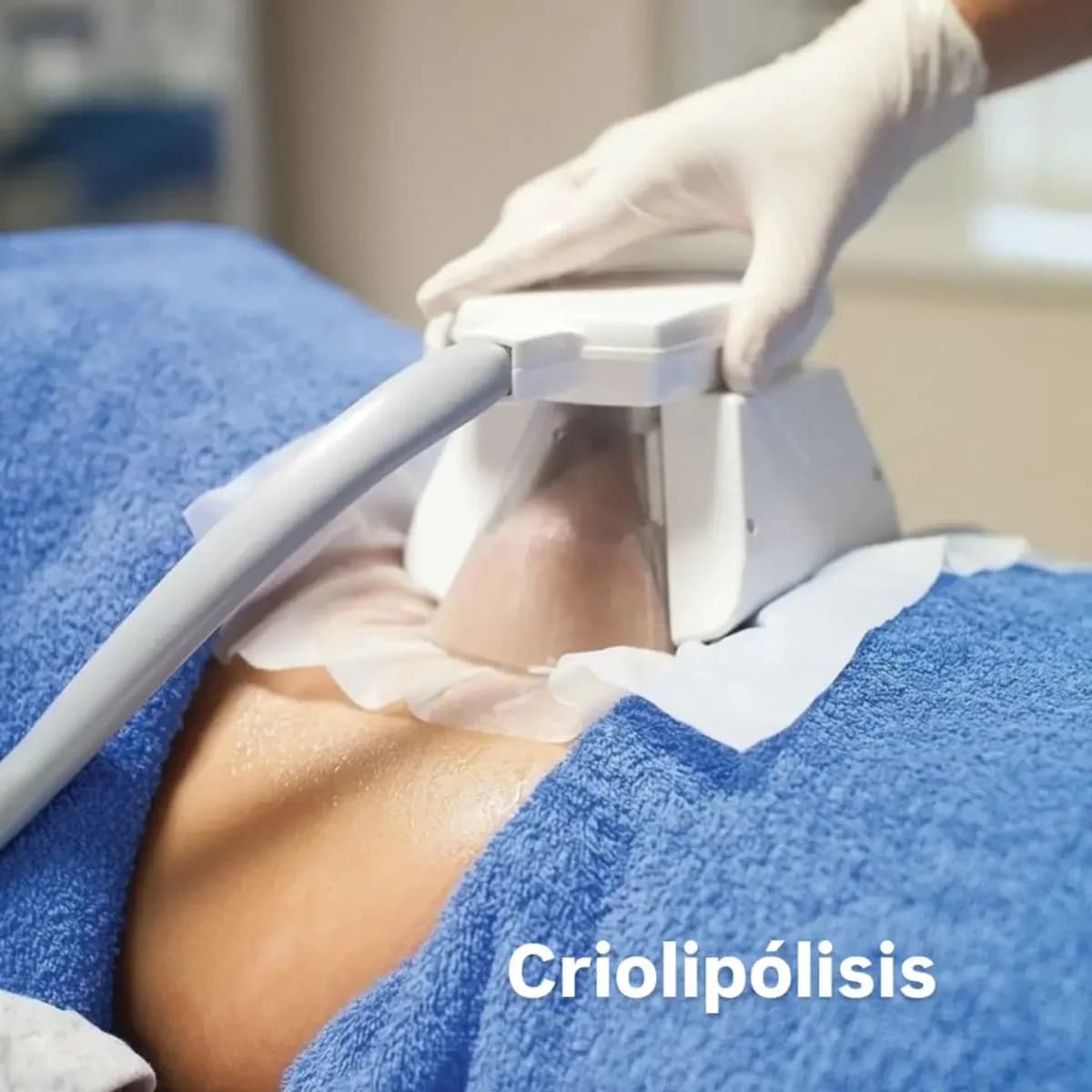 Criolipólisis