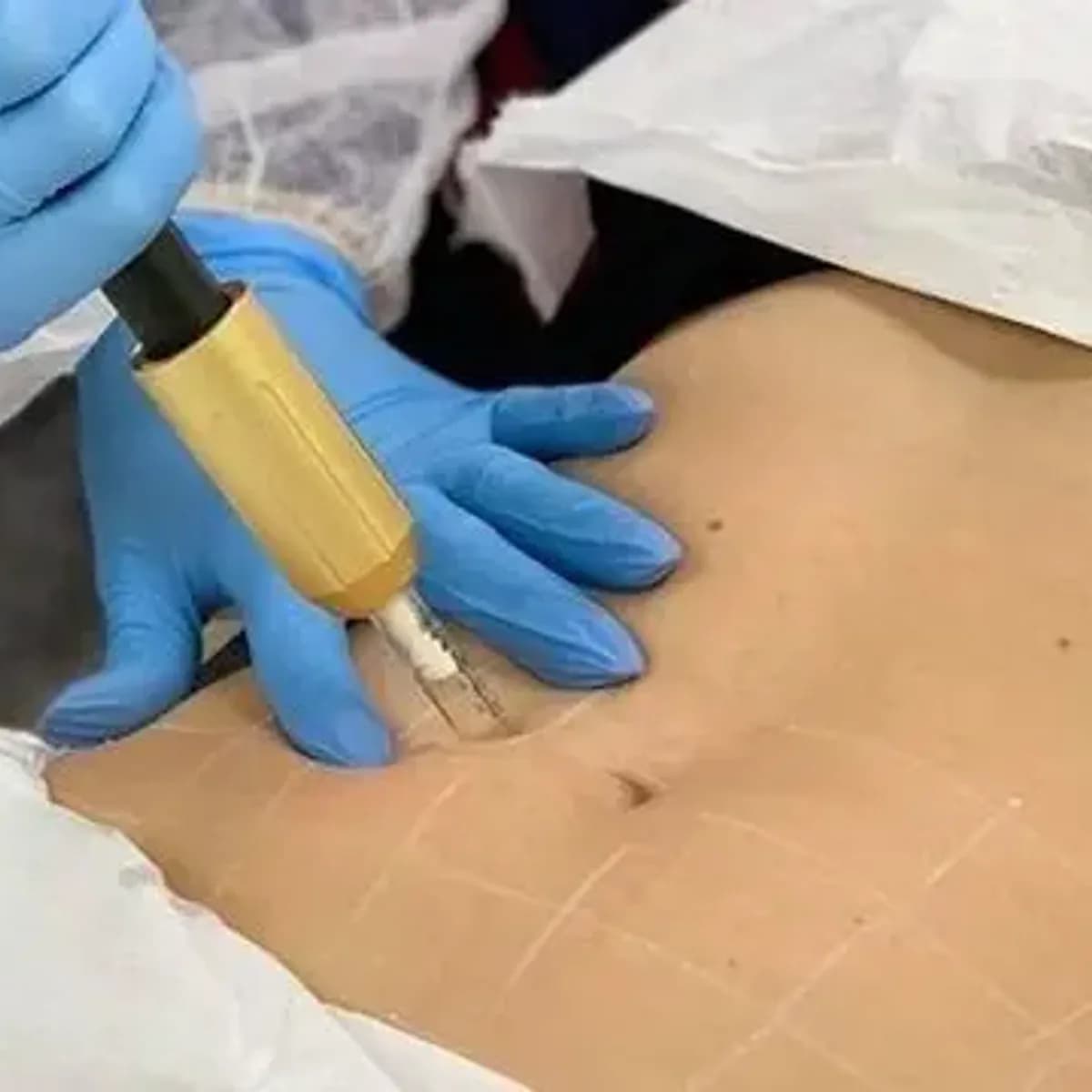 MESOTERAPIA CON HYALURON PEN