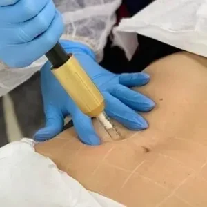 MESOTERAPIA CON HYALURON PEN